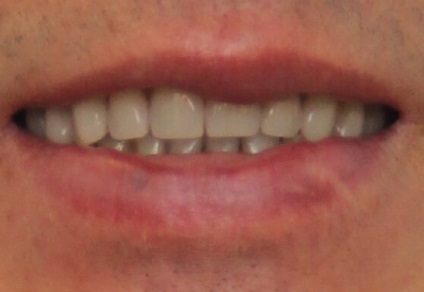 Az implantáció alsó fogak (komplikáció) Az implantáció az alsó fogak