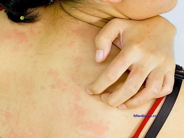 Fertőző dermatitis tünetei, diagnózis és kezelés (dermatitisz) Fertőző dermatitis tünetei, diagnózisa és kezelése