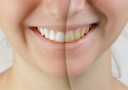 Mi a jobb tömítés az elülső fogak anyagválasztás