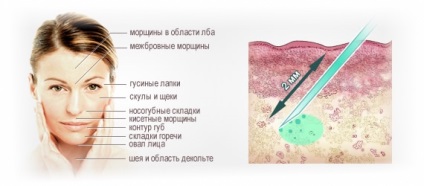 Milyen gyakran lehet és kell tenni biorevitalisation (lehetséges) Milyen gyakran lehet és kell tenni biorevitalisation