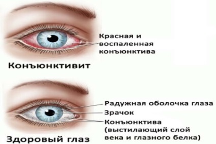 Mivel a szemmosó tea kötőhártyagyulladás (conjunctivitis) Mivel a tea öblítse ki a szemet kötőhártya