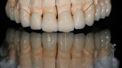 Hogyan törődik a fogak Cermetből, kivehető és rögzített fogpótlások
