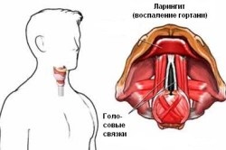 Hogyan vissza a hangját, amikor gégegyulladás