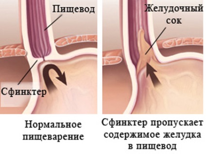 Cardia nem teljesen lezár, nyelőcső wiki