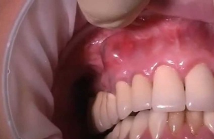 Ciszta az íny - fotók, videók, leírások a klinikai esetek (gumi) Ciszta az íny - fotók, videók, leírások a klinikai esetek