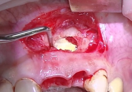 Ciszta az íny - fotók, videók, leírások a klinikai esetek (ciszta gumi fotó) Ciszta az íny - fotók, videók, leírások a klinikai esetek