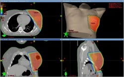 CT-a mell, emlő CT diagnosztika (képalkotás) CT-a mell, emlő CT Diagnózis