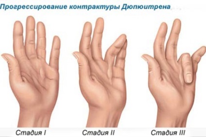 Dupuytren (betölt napon belül) Dupuytren