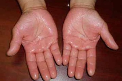 Dupuytren (Dupuytren) Dupuytren