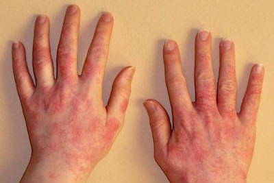 Vörös foltok a bőr viszketése (allergiás), azaz a kezelés viszketés