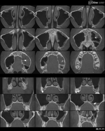 Ct a diagnózis betegségek a orrmelléküregek