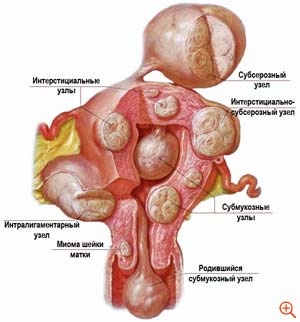 Laparoszkópia Méh mióma (miómák) A laparoszkópia Méh miómák