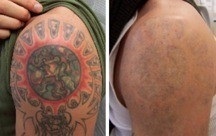 A tetoválás lézeres eltávolítása - a legjobb módja annak, hogy csökkentsék a nem kívánt tetoválás