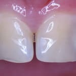 A legjobb fogkrém a fogszuvasodás ellen annak összetételét és a hatékonyság