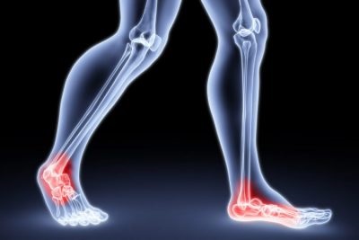 Metatarsalgia Foot tünetei és kezelése