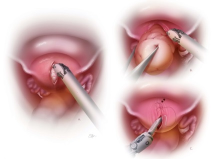 Méh fibroid mérete működésre milliméterben