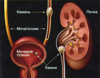 Urolithiasis (6)