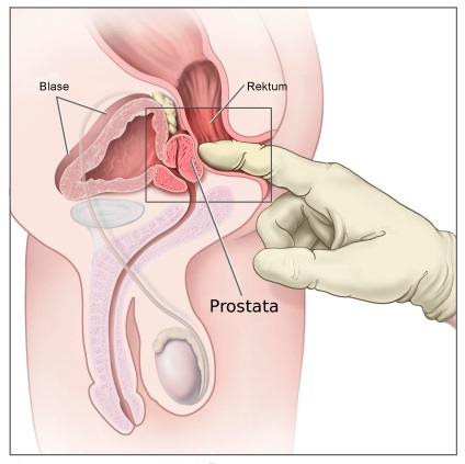 ciszta a prosztatában a prostatitis)