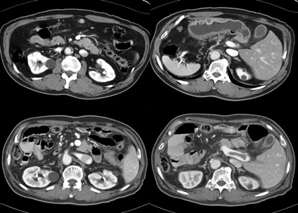 MRI mellékvese bizonyság, mint ahogy, ár, előkészítés (mellékvese) MRI mellékvese bizonyság, mint ahogy, ár, előkészítése