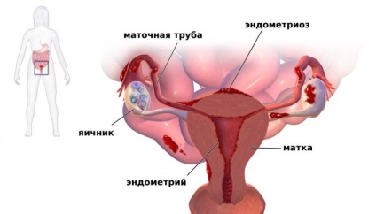 Norkolut vagy djufaston, hogy a jobb (djufaston) Norkolut vagy djufaston, hogy a jobb