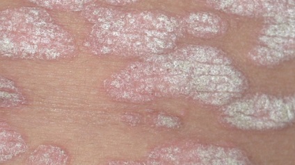 A psoriasis fellángolása, mit kell tenni, hogyan lehet gyorsan és hatékonyan elősegíti a visszaesés