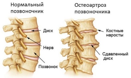 Osteoarthritis a gerinc és a tünetek (a porc) Osteoarthritis a gerinc és tünetei