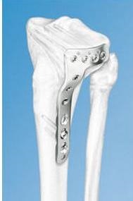 Csontösszekötő magas a jelenlegi kezelések (blokkolt intramedulláris osteosynthesis BIOS) Csontösszekötő nagy folyó kezelések