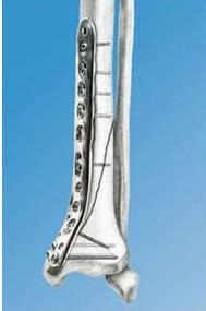 Csontösszekötő nagy folyó kezelések (intra osteosynthesis BIOS) Csontösszekötő nagy folyó kezelések