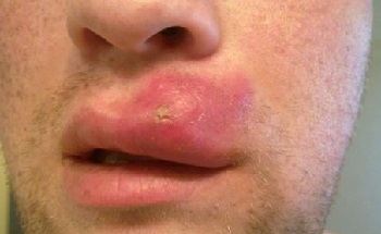 Набряк губ і його причини - алергія, травми, виразки і хвороби