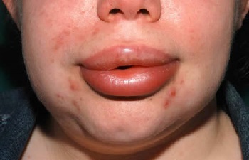 Набряк губ і його причини - алергія, травми, виразки і хвороби