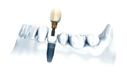 Elutasítása fogászati implantátumok jelek, tünetek, okok (elutasítás) Elutasítása fogászati implantátumok jelek, tünetek, okok