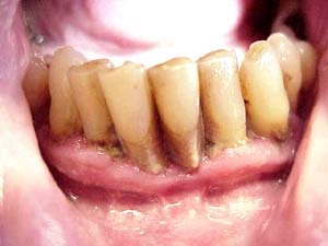A periodontális betegség - kezelésére emberek jogorvoslatok