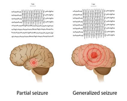 Részleges epilepszia és generalizált rohamok, tünetei és kezelése