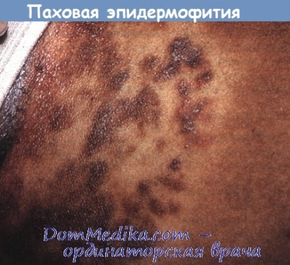 Inguinalis tinea - diagnózis, kezelés