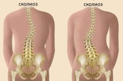 Úszás scoliosis