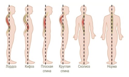 Úszás scoliosis