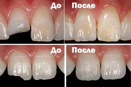 A pecsét az első fogak - hogyan tegye, hogy mennyibe kerül, és hogyan, hogy egy tömítés