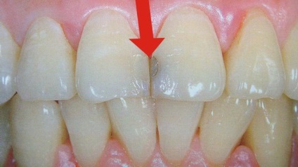 Tömítő elülső fogak fotó tömítéseket az elülső foga