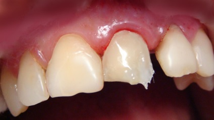 Tömítő elülső fogak fotó tömítéseket az elülső foga