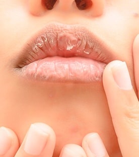 Miért száraz ajkak okok és betegség