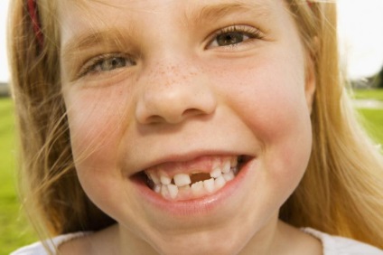 Megfeketedett fogak - mi a teendő megfeketedett fogak a gyermek