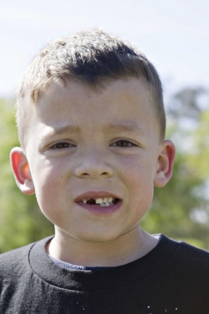Megfeketedett fogak - mi a teendő megfeketedett fogak a gyermek