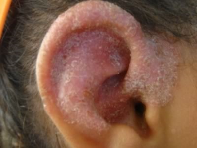 Okai, típusai, dermatitis a füle
