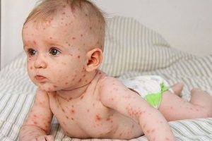 Akne és a hőmérséklet az oka a gyermek, a diagnózis (oka) Akne és a hőmérséklet egy gyerek okozza a diagnosztika