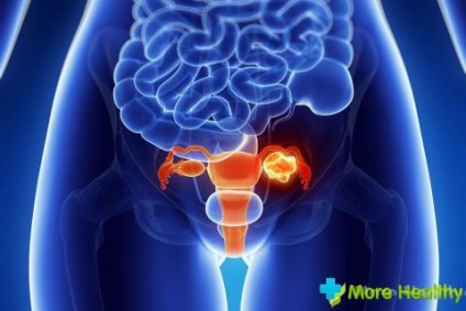 Tünetei és kezelése intramurális méhleiomioma (leiomyoma) Tünetei és kezelése intramurális méhleiomioma