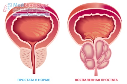 A prosztatagyulladás tünetei, jelei és típusai, diagnózisa és kezelése prosztatagyulladás férfiaknál