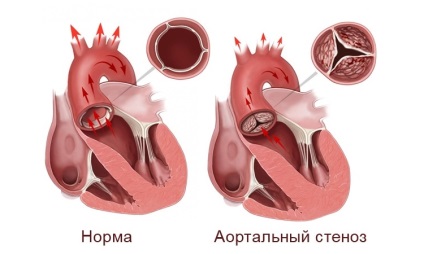 Megnyilvánulások, diagnózis és kezelés taktika az aorta szívbetegség (megnyilvánulása) Megnyilvánulások, diagnózis és kezelés taktika az aorta szívhiba
