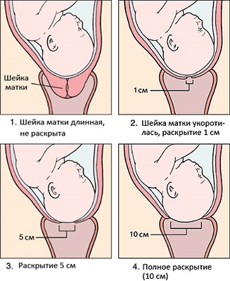 Розкриття шийки на 3 пальці народжувати