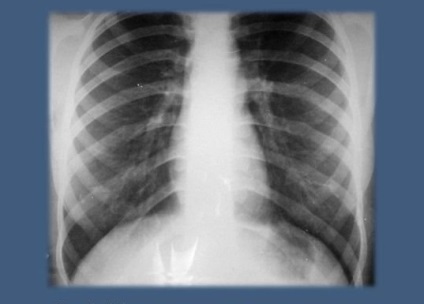 X-ray a tüdőben a hörghurut néz ki, mint X-ray (a fény) X-ray, a tüdő bronchitis néz ki, mint az X-ray