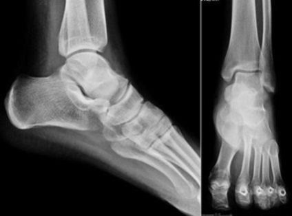 X-sugarak a láb és a gazdaság (ragadós röntgendiagnosztikában a lúdtalp) X-sugarak a láb és a gazdaság